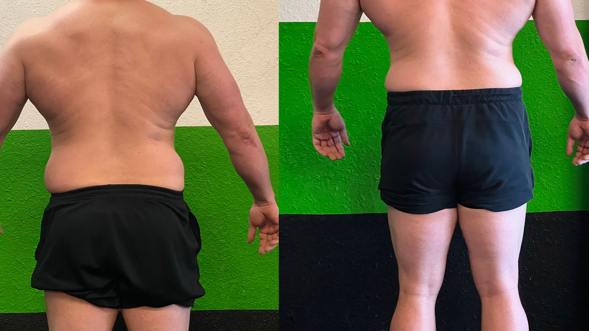 Emsculpt Neo Edge Before and After