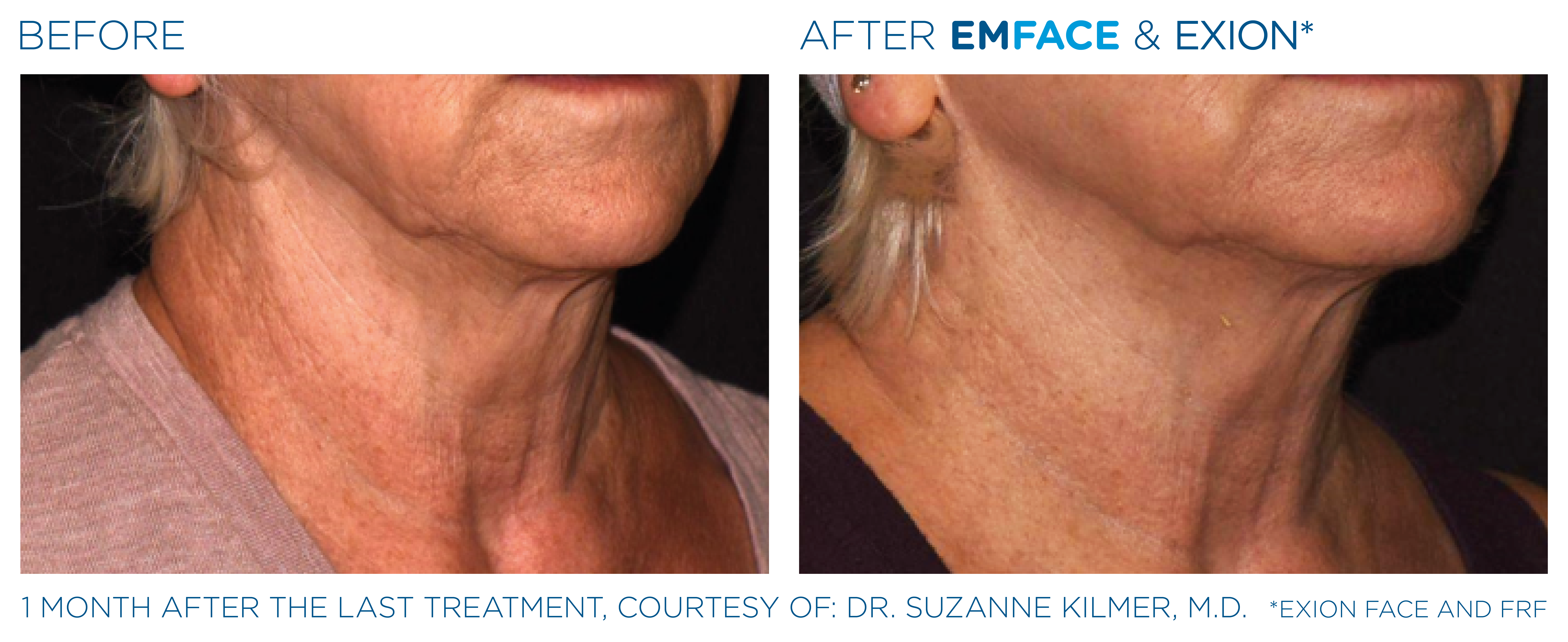 Non-Surgical Facelift Necklift Alternative Bellevue WA Elevated MedSpa
