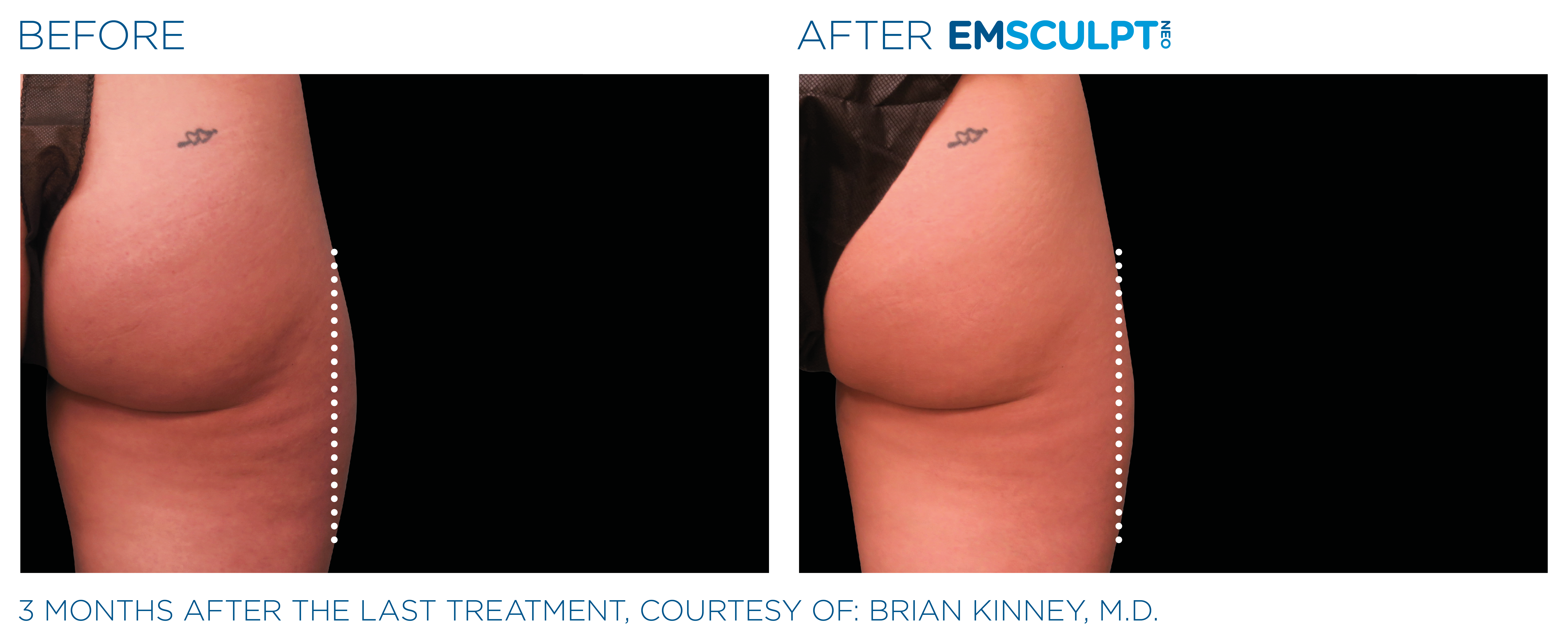 Body parts that can be treated with Emsculpt NEO