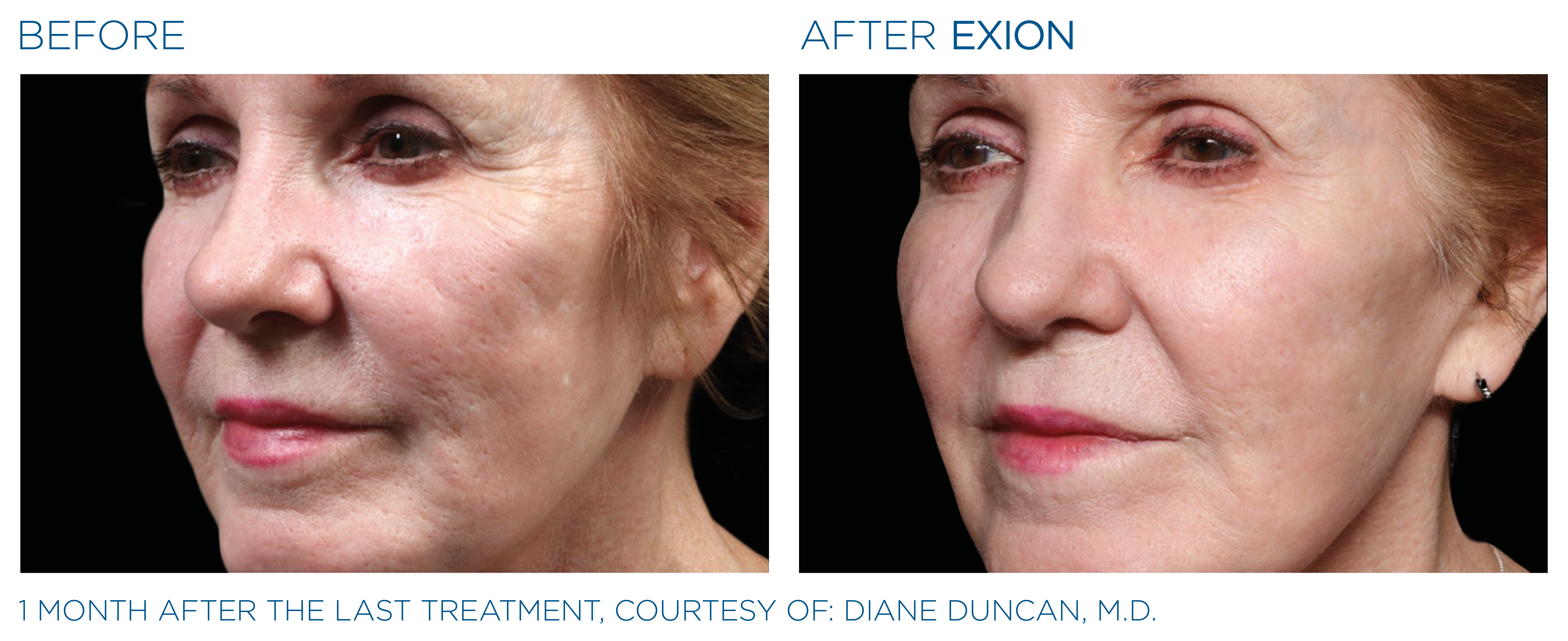 Non-Surgical Facelift Ultherapy Alternative Bellevue WA Elevated MedSpa