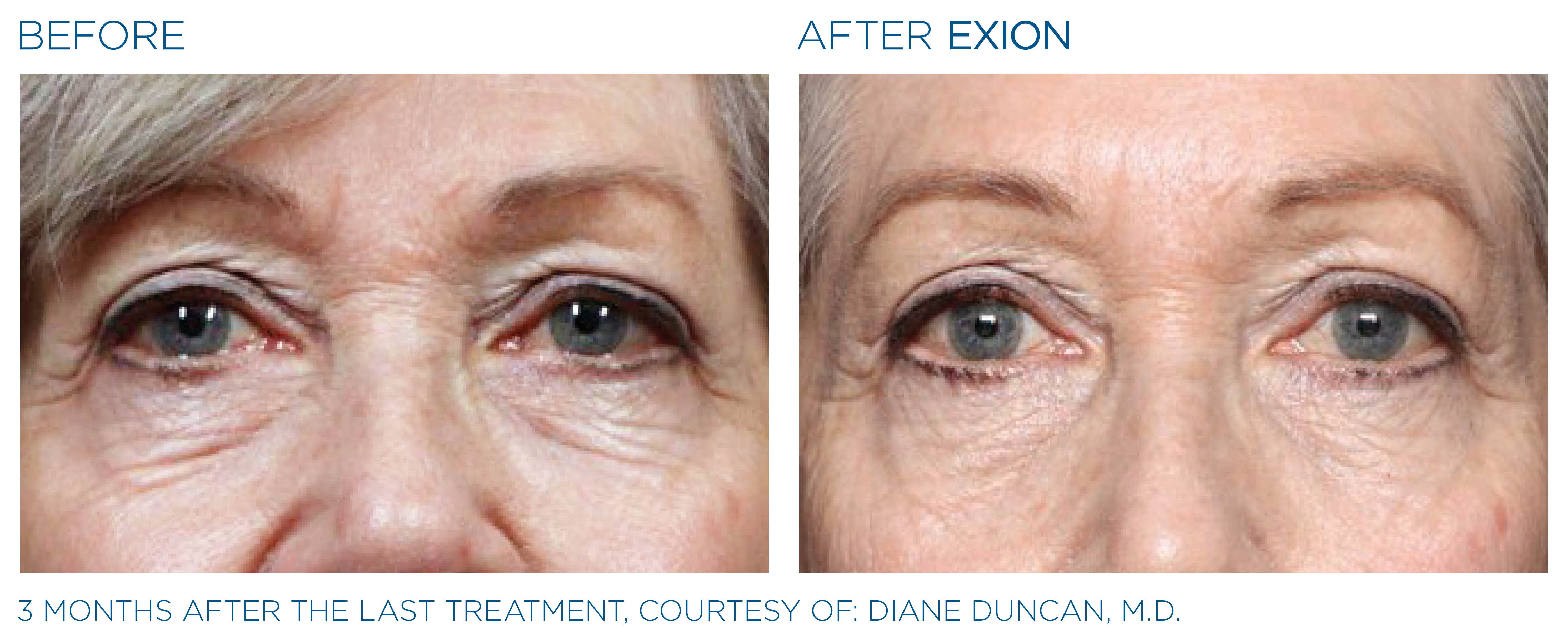 Non-Surgical Facelift Alternative Bellevue WA Elevated MedSpa