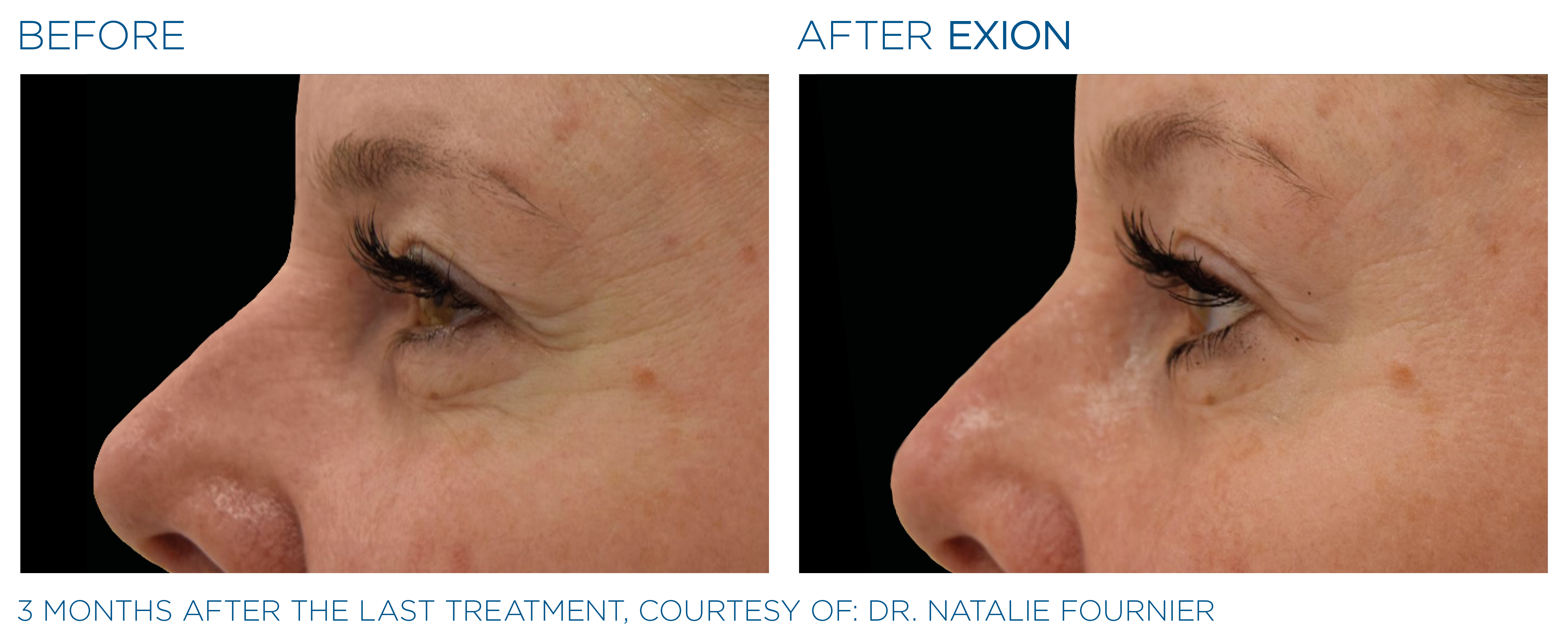 Non-Surgical Facelift Eye lift Facelift Alternative Bellevue WA Elevated MedSpa