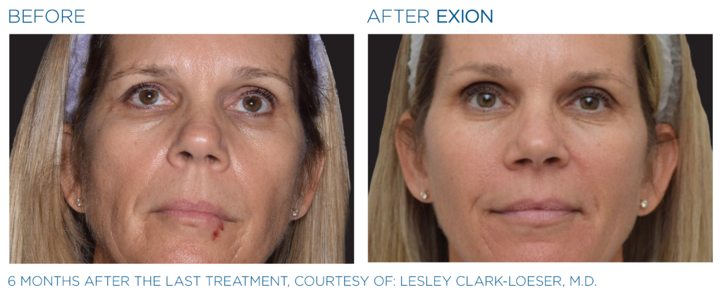 Non-Surgical Facelift Alternative Bellevue WA Elevated MedSpa