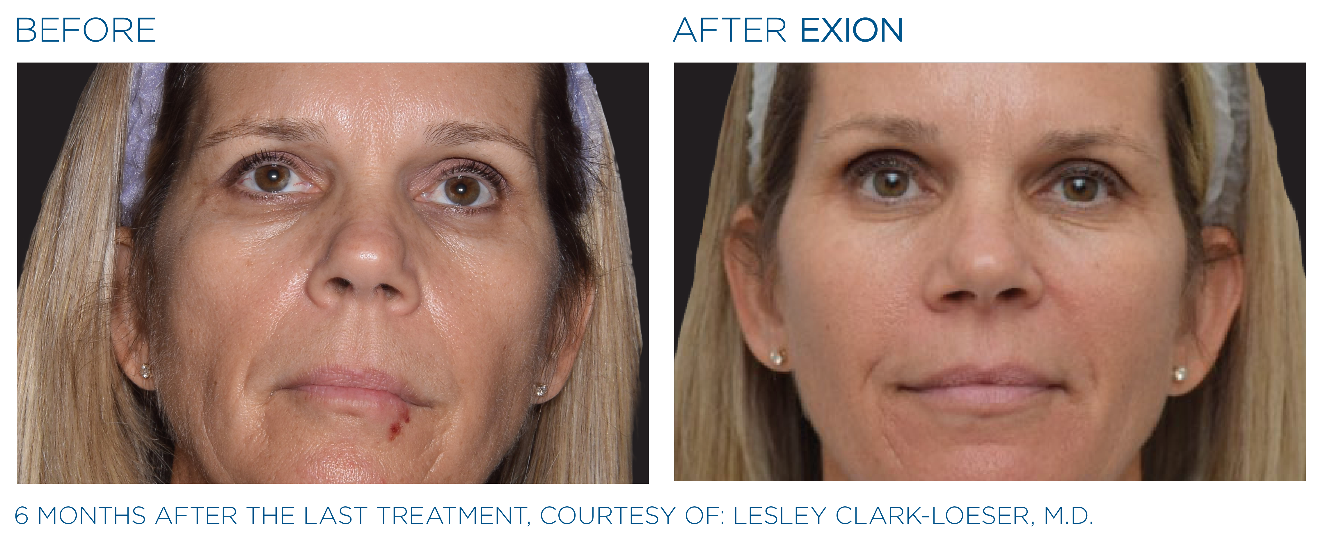Non-Surgical Facelift Alternative Bellevue WA Elevated MedSpa