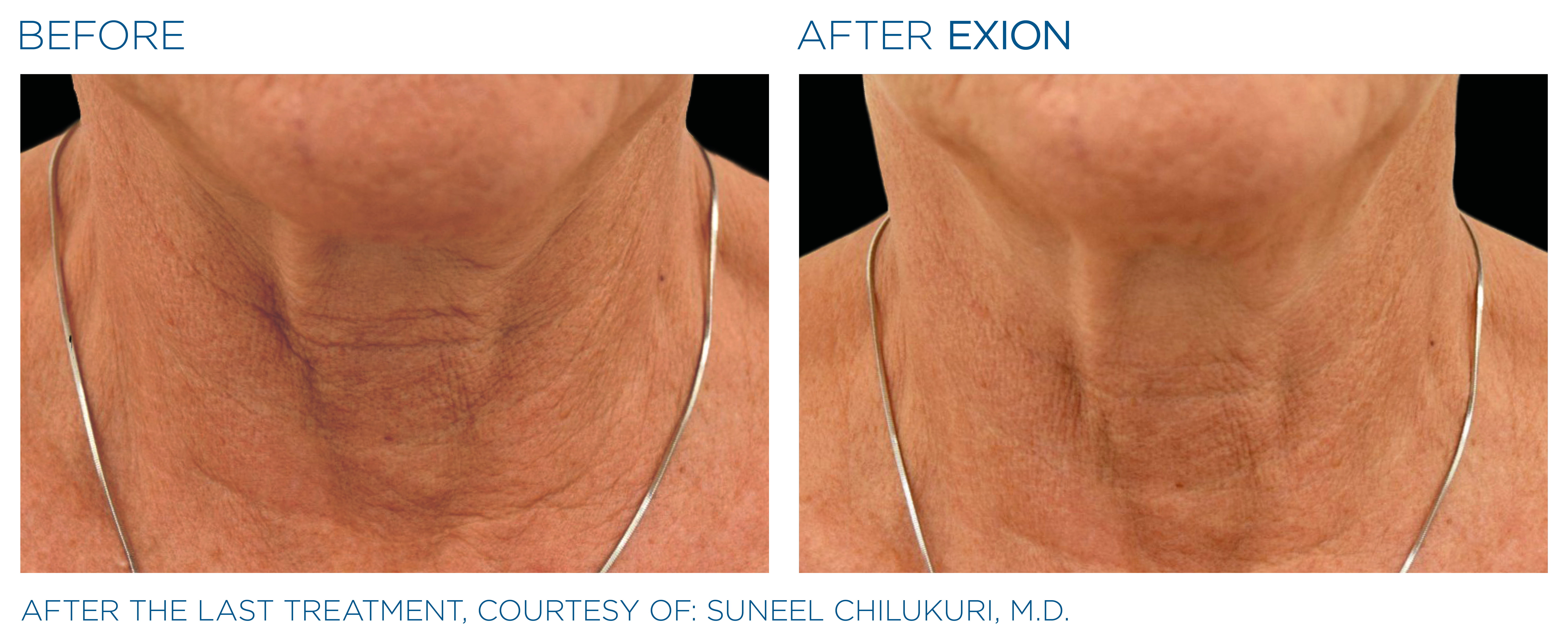 Non-Surgical Facelift Neck lift Alternative Bellevue WA Elevated MedSpa