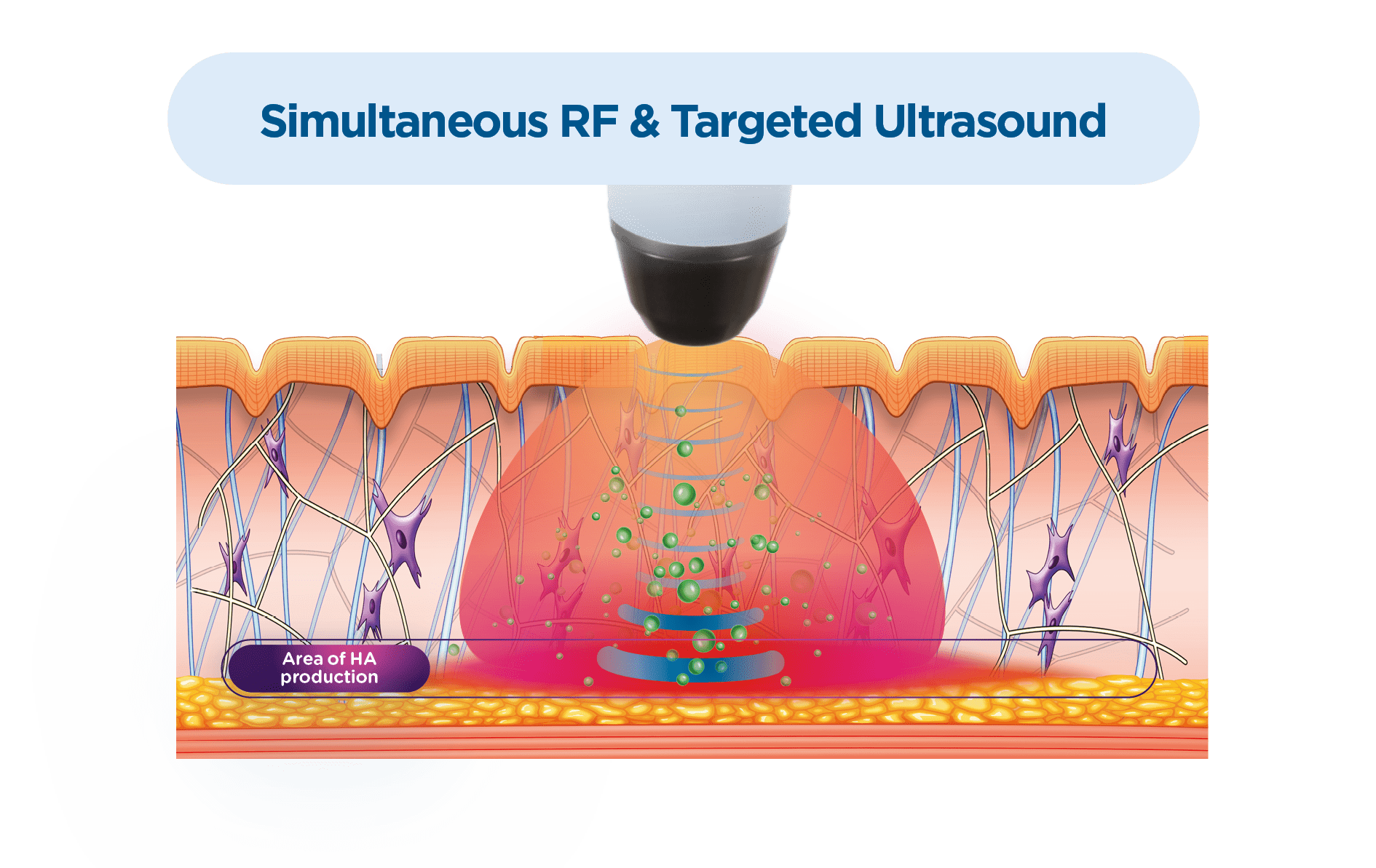 Exion RF & Targeted Ultrasound at Tahoe Emsculpt