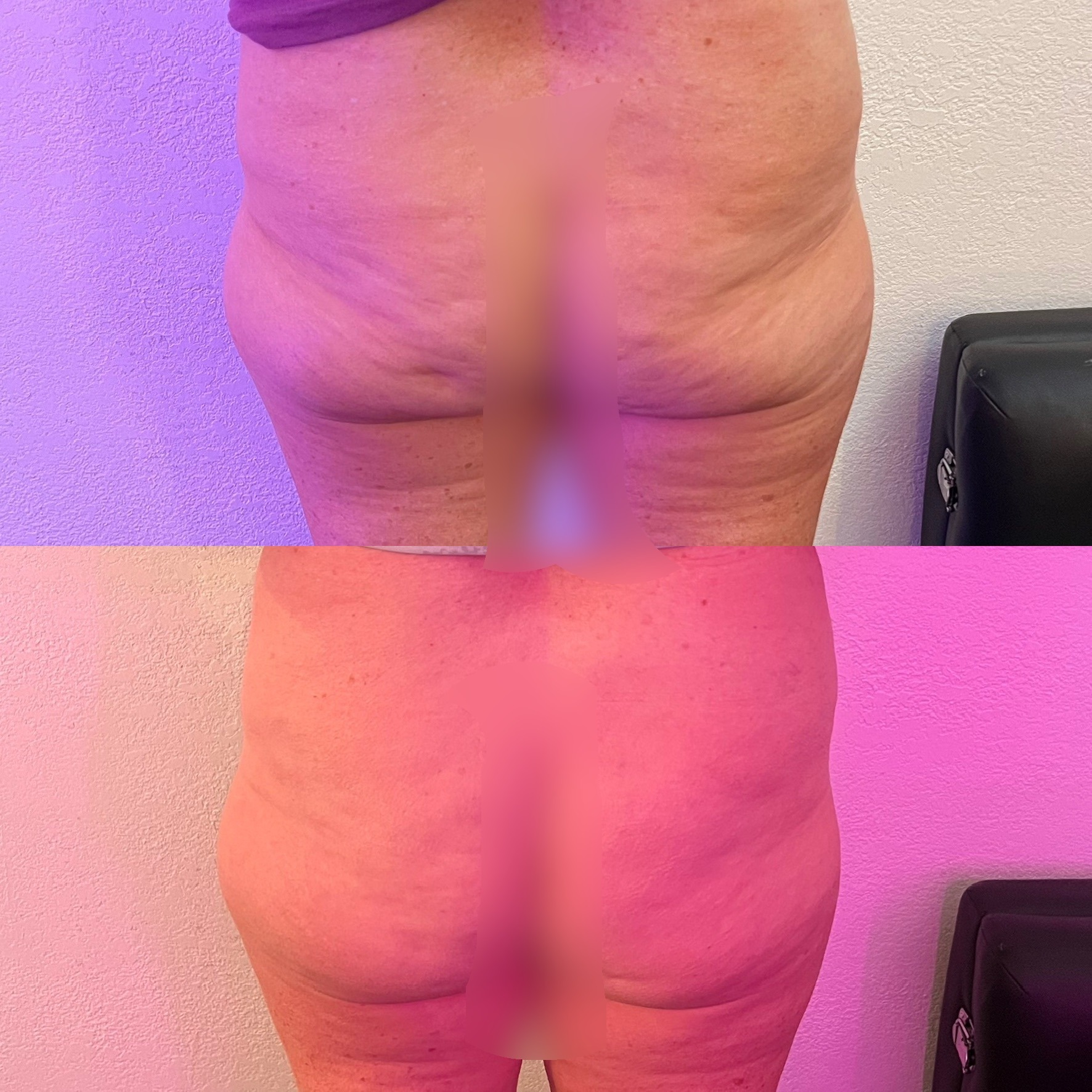 Emsculpt NEO Before and After