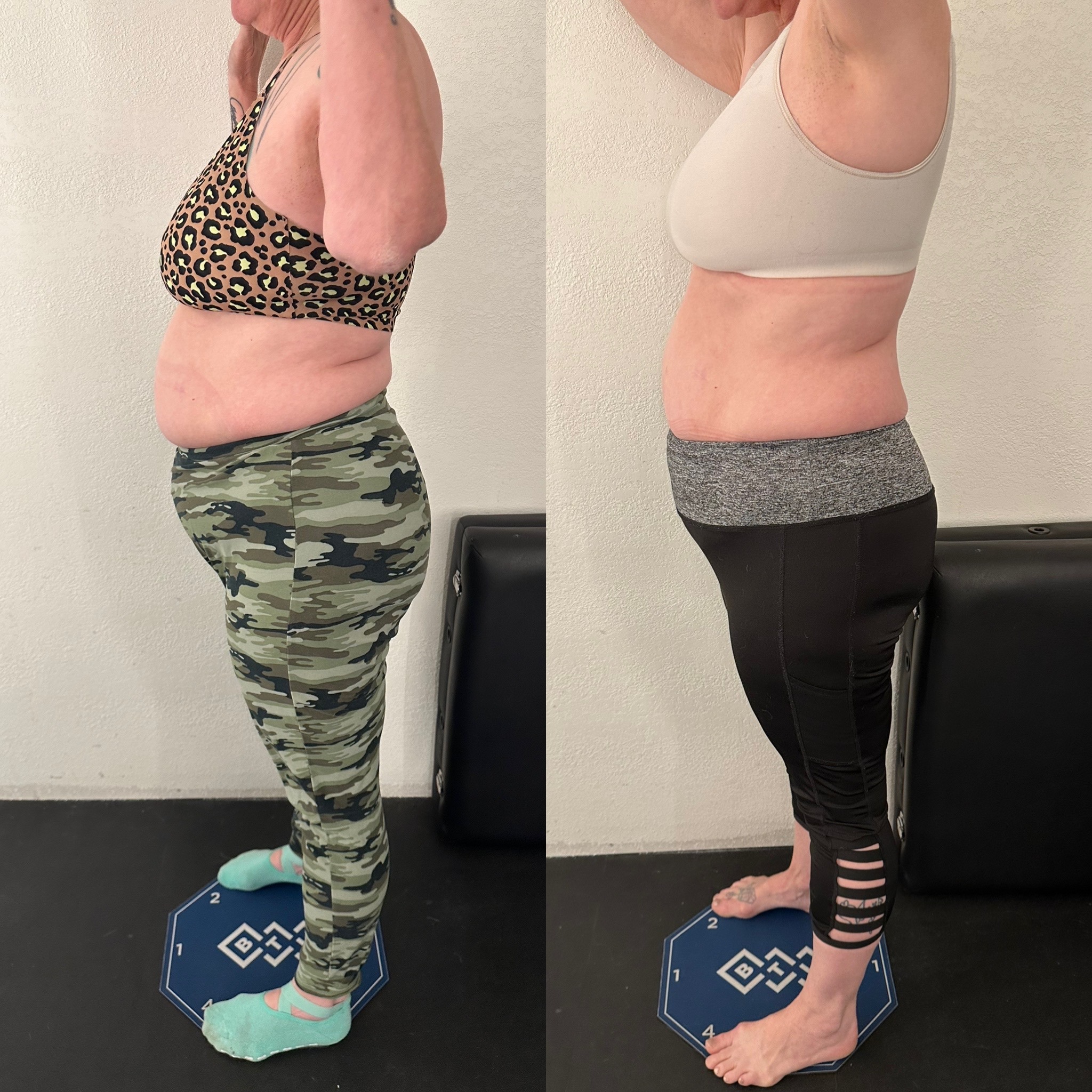 Emsculpt NEO Before and After