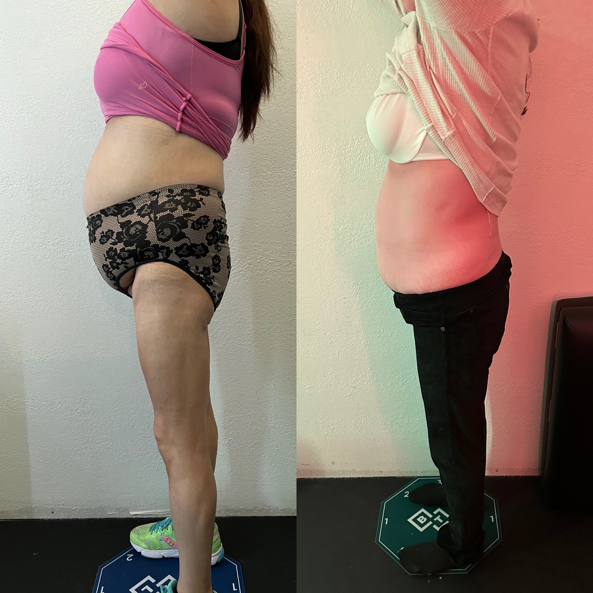Emsculpt NEO Before and After