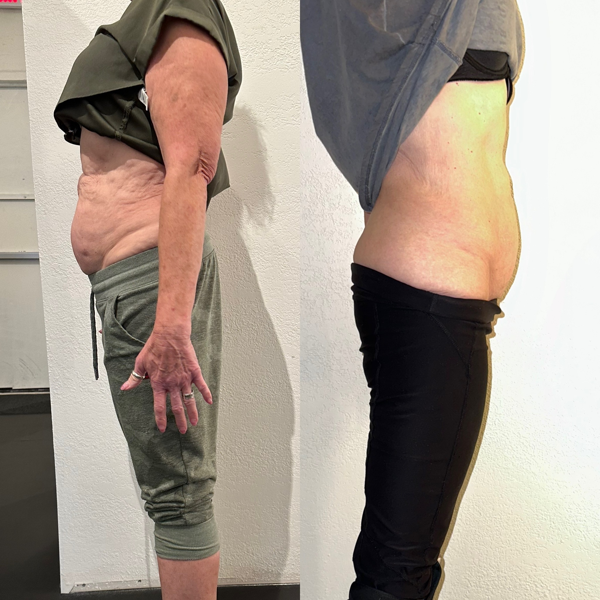 Emsculpt NEO Before and After
