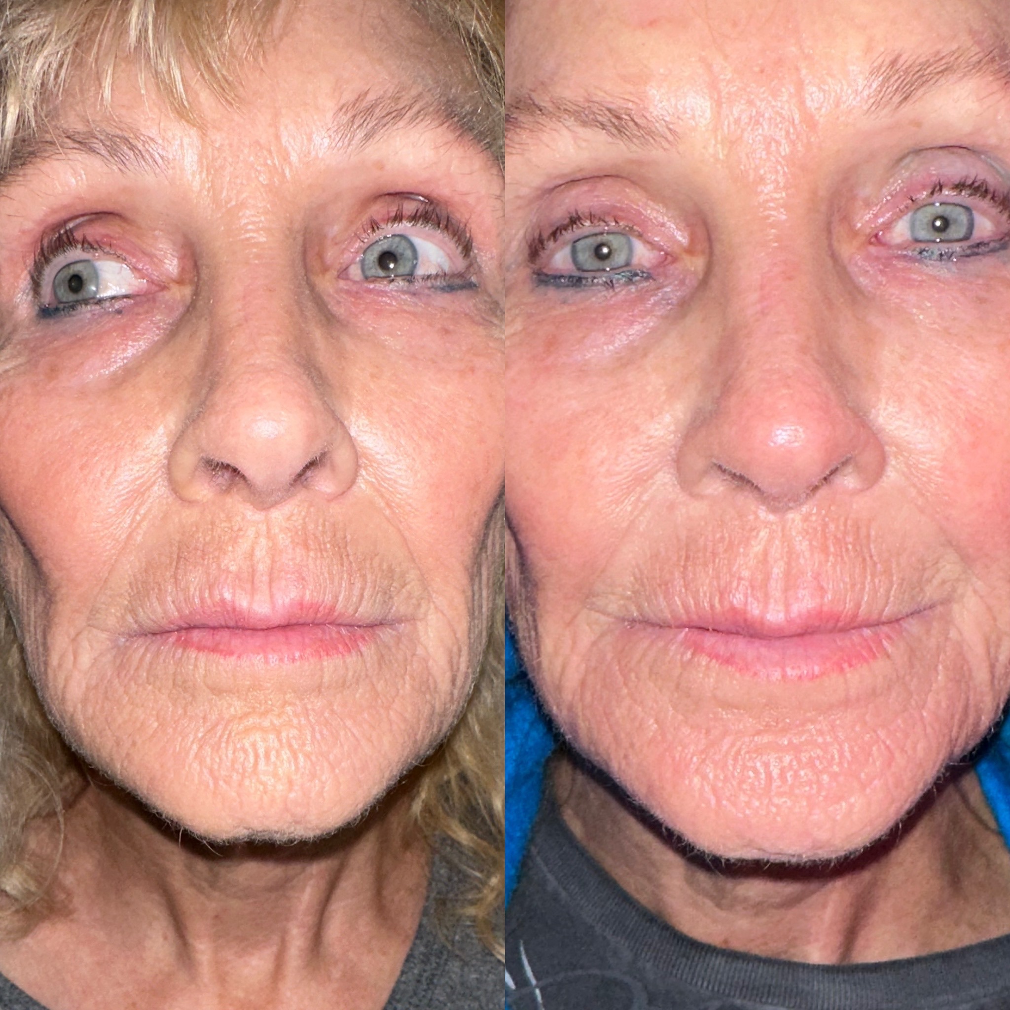 Exion Before and After