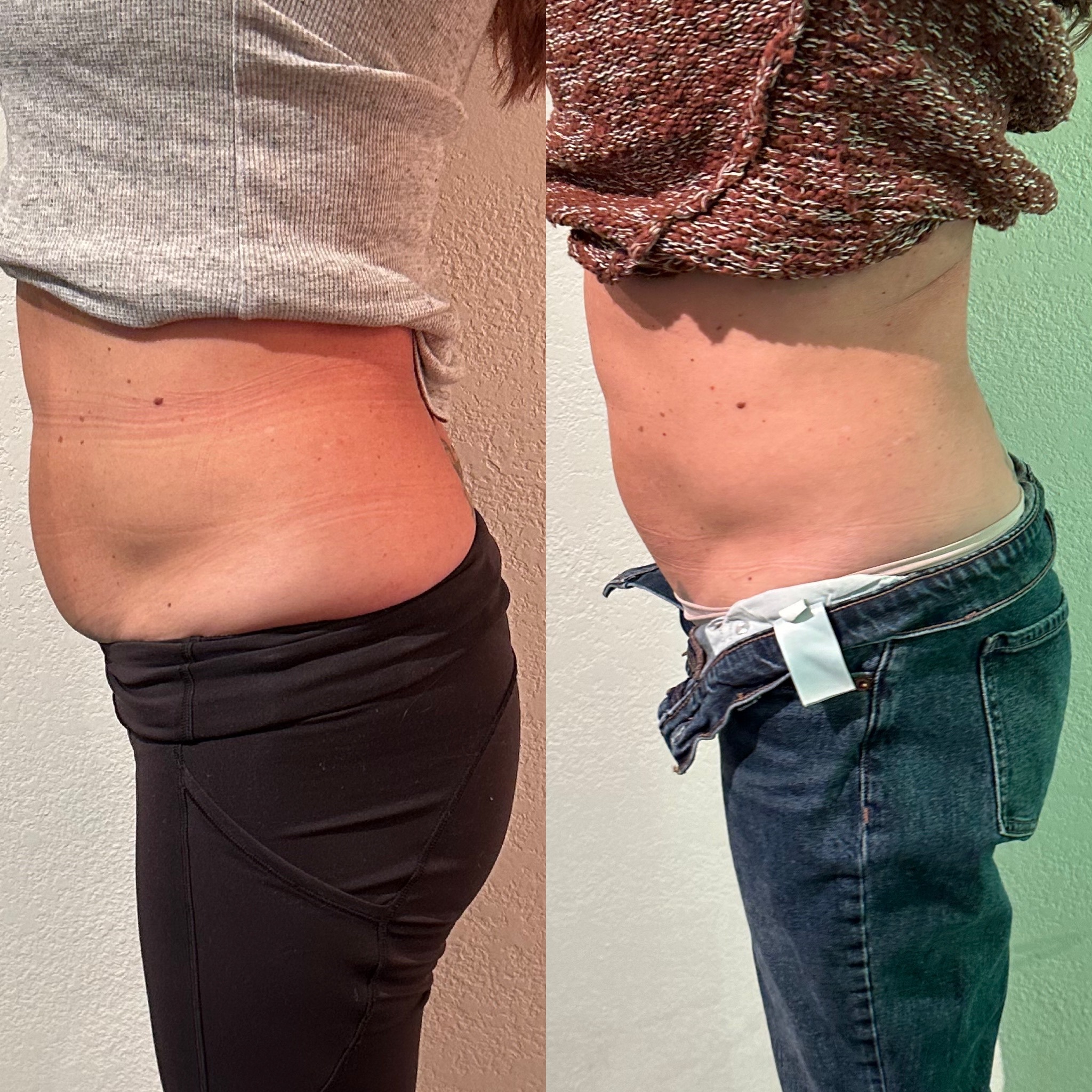 Emsculpt NEO Before and After