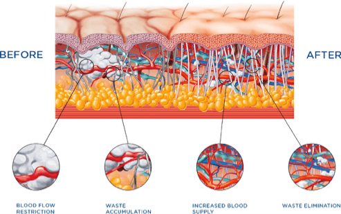 How Does EMTONE/Cellutone Work at Tahoe Esculpt