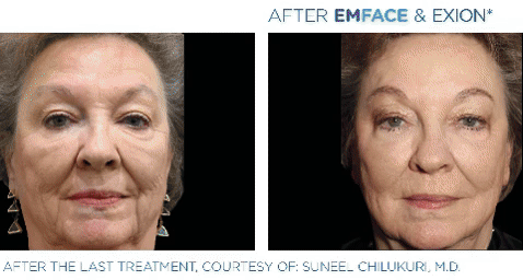 Elevated MedSpa EmSuite Before and After