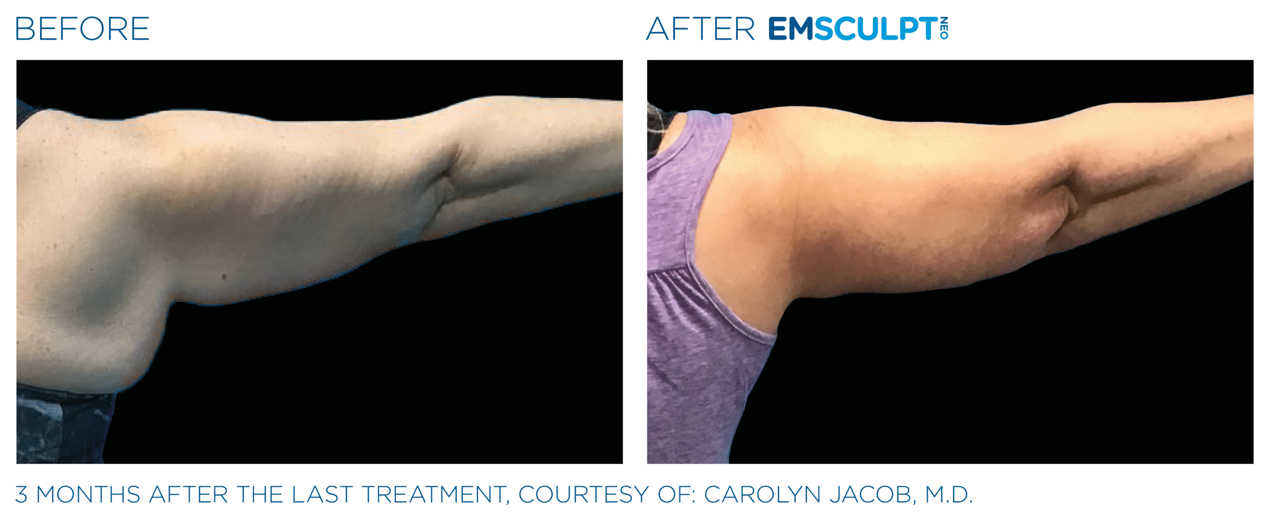 Before and after results from Emsculpt NEO and Exion arms treatment at Elevated MedSpa in Bellevue, WA