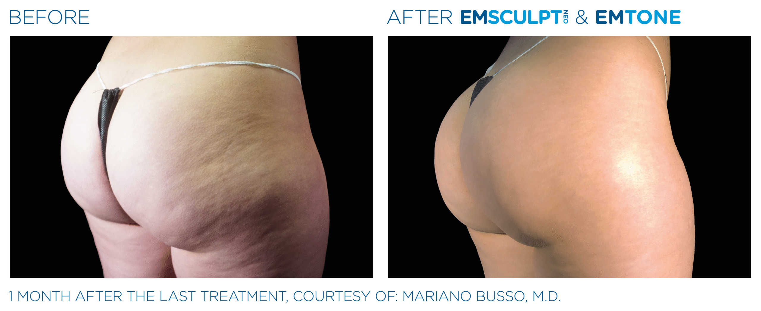 Before and after results from Emsculpt NEO and Exion glutes treatment at Elevated MedSpa in Bellevue, WA