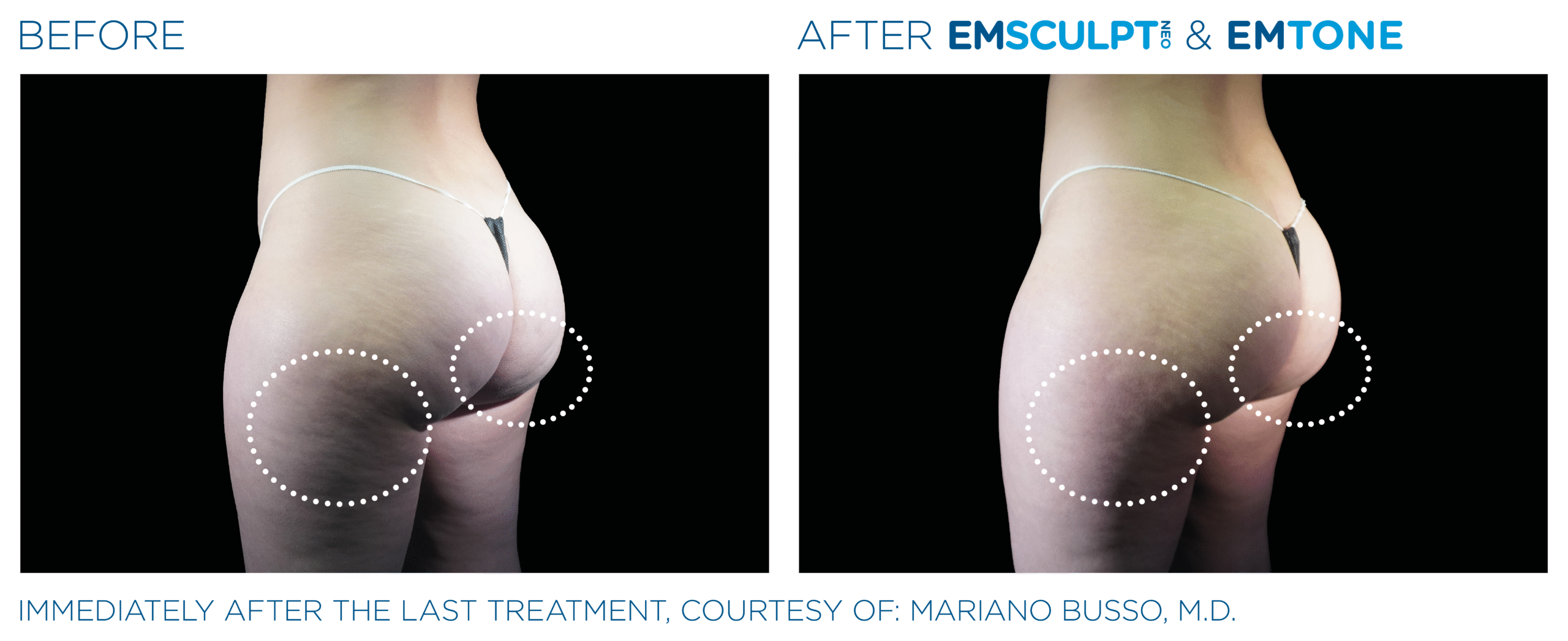 Before and after results from Emsculpt NEO and EmTone legs treatment at Elevated MedSpa in Bellevue, WA