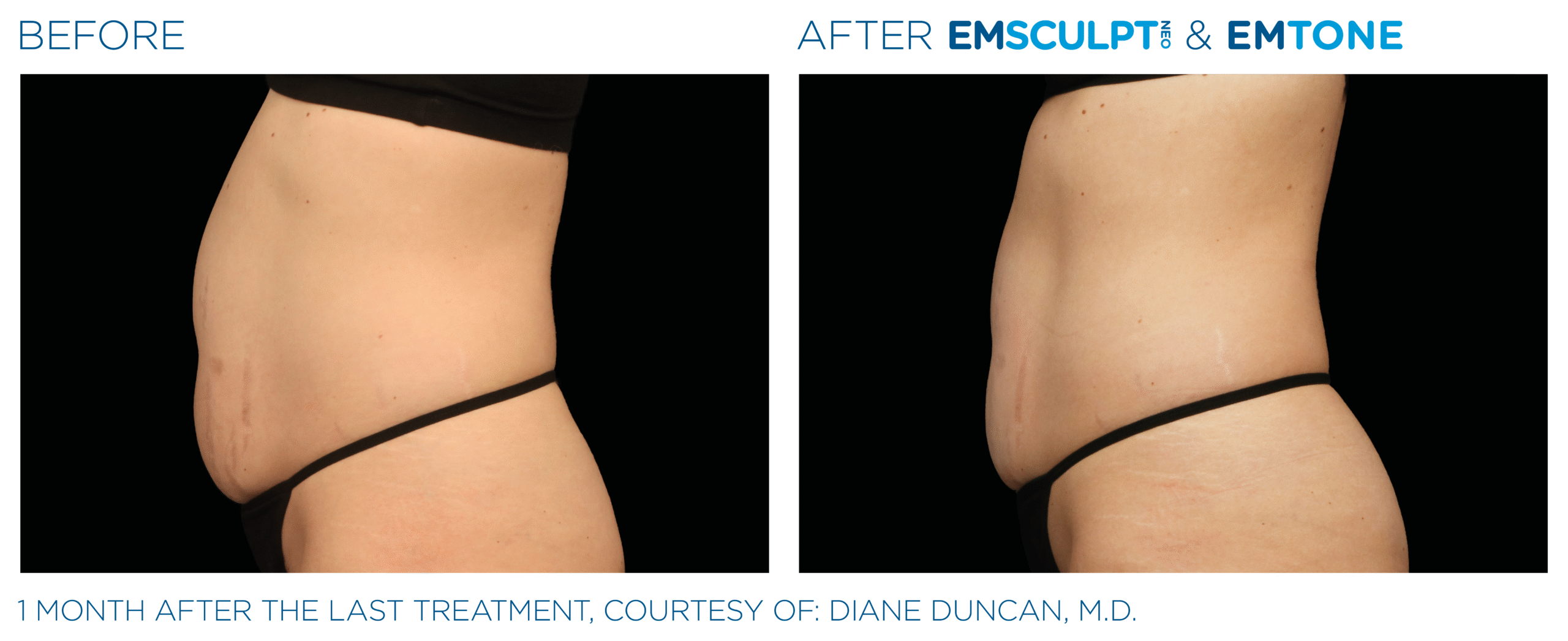 Before and after results from Emsculpt NEO and Exion abdominal treatment at Elevated MedSpa in Bellevue, WA