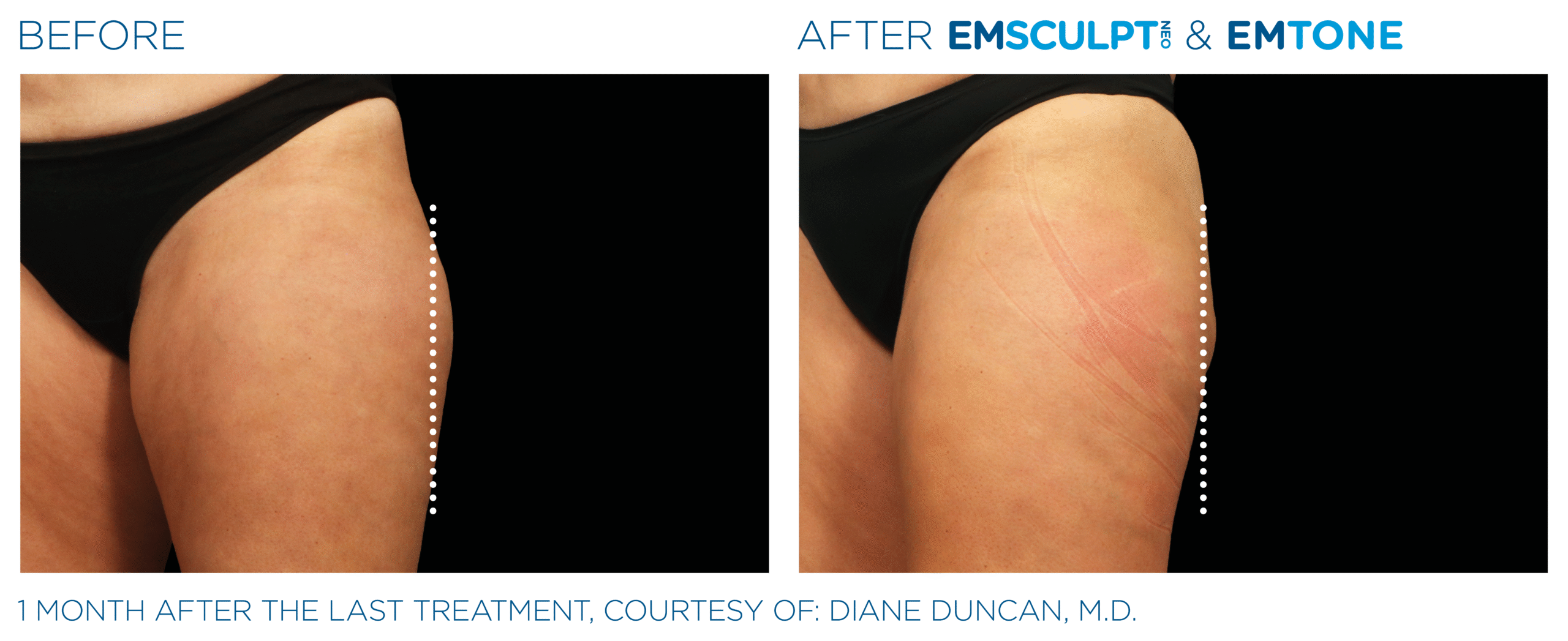 Before and after results from Emsculpt NEO and Exion thight treatment at Elevated MedSpa in Bellevue, WA
