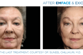 Non-Surgical Facelift Alternative Bellevue WA Elevated MedSpa