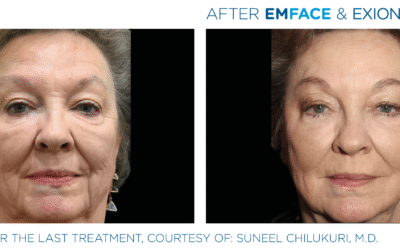 Non-Surgical Facelift Alternative Bellevue WA Elevated MedSpa