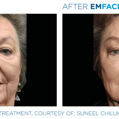 Non-Surgical Facelift Alternative Bellevue WA Elevated MedSpa