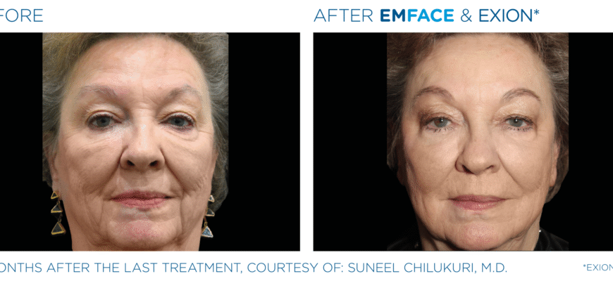 Non-Surgical Facelift Alternative Bellevue WA Elevated MedSpa