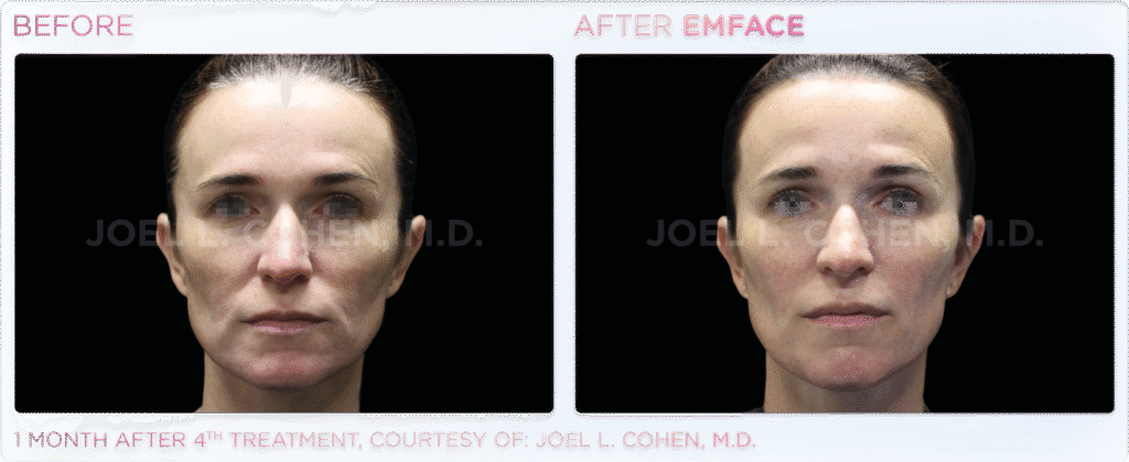 Non-Surgical Facelift Alternative Bellevue WA Elevated MedSpa