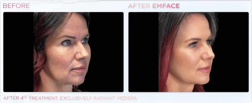 Non-Surgical Facelift Alternative Bellevue WA Elevated MedSpa