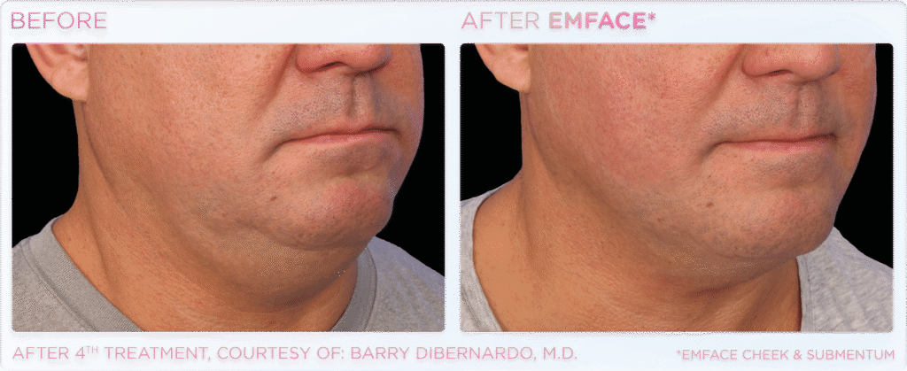 Non-Surgical Facelift Double Chin lift Alternative Bellevue WA Elevated MedSpa