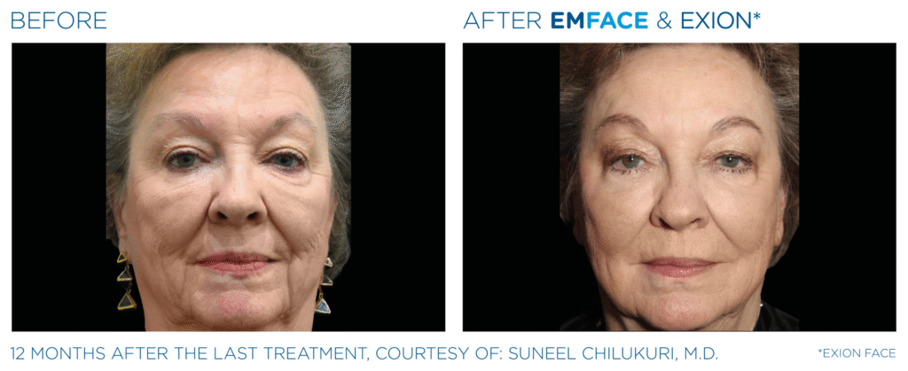 Non-Surgical Facelift Alternative Bellevue WA Elevated MedSpa