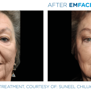 Non-Surgical Facelift Alternative Bellevue WA Elevated MedSpa
