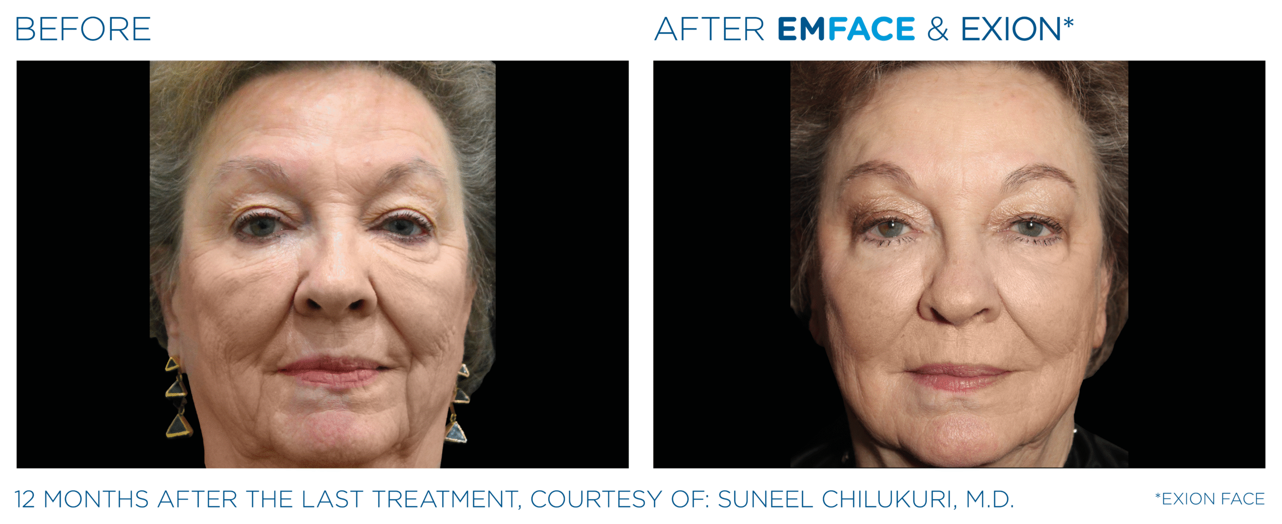 Non-Surgical Facelift Alternative Bellevue WA Elevated MedSpa